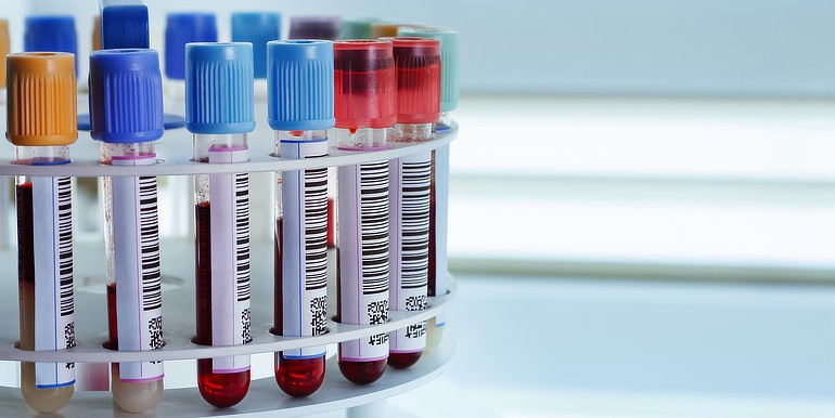 Serum marker offer alternative for colorectal cancer detection