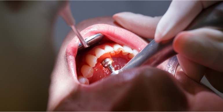 Evidence mounts of link between severe gum disease and various cancers