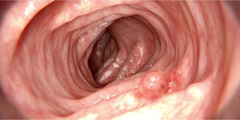 The IARC perspective on colorectal cancer screening