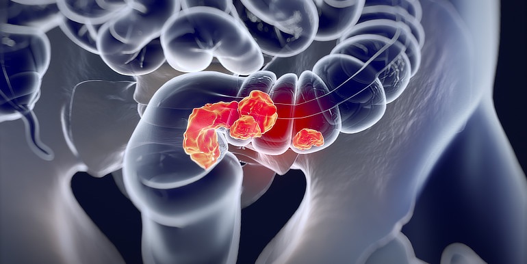 Bezpříznakové období rakoviny tlustého střeva může trvat roky, varuje lékař